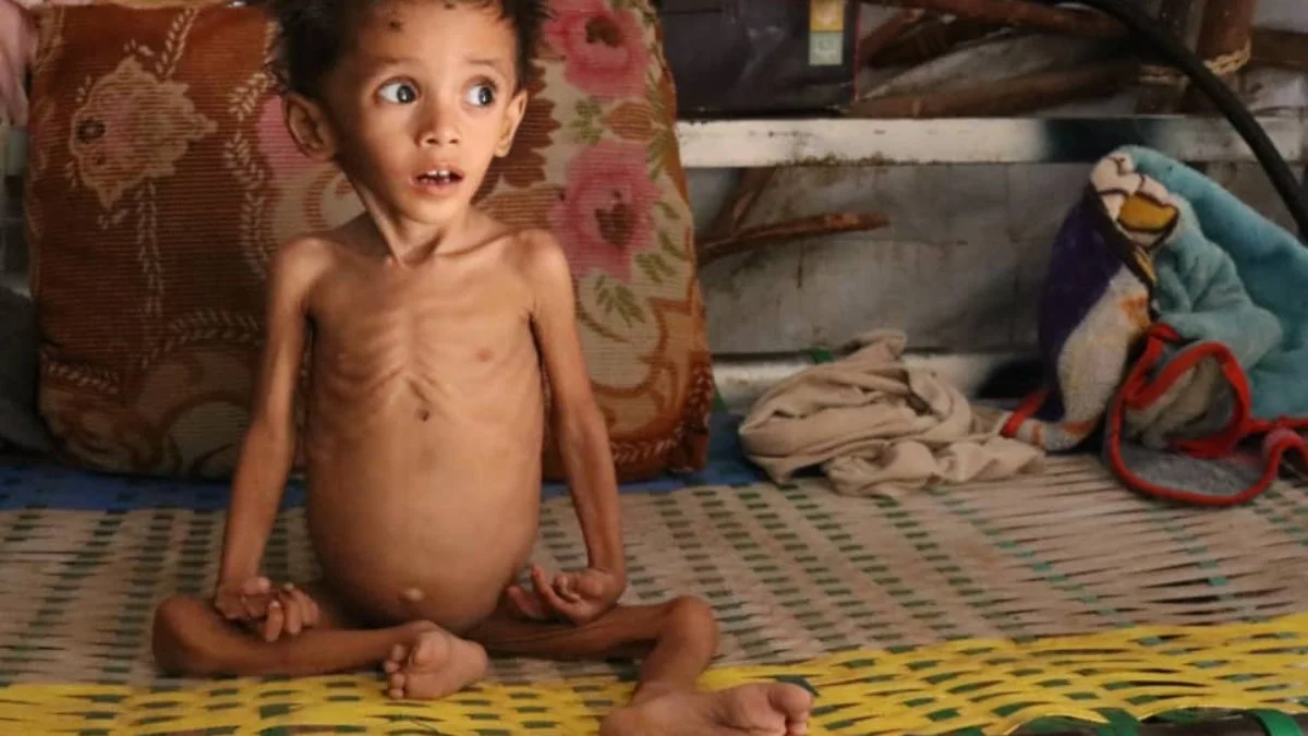 Acute-malnutrition-in-yemen-1200x675